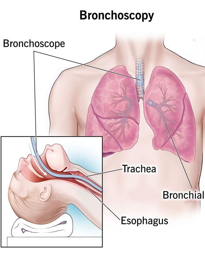 Bronchoscopy