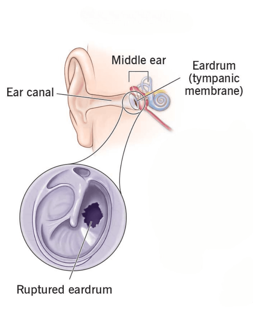 Middle Ear Reconstruction